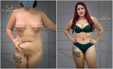 Lipoabdominoplastia - Dr. Brian Frick