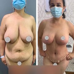 Abdominoplastia - Dr. Brian Frick 