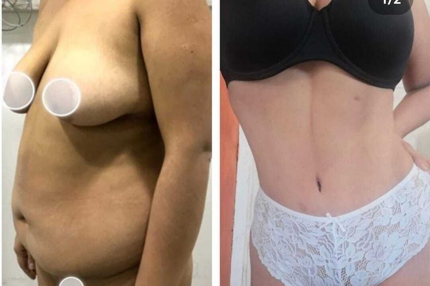 Liposucción antes y después - 836776
