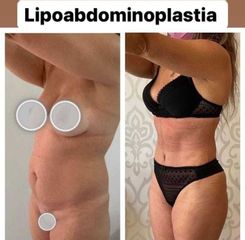 Adbominoplastia - Dr. Brian Frick