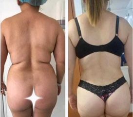 Lipoescultura - Dr. Brian Frick
