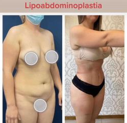 Lipoabdominoplastia - Dr. Brian Frick