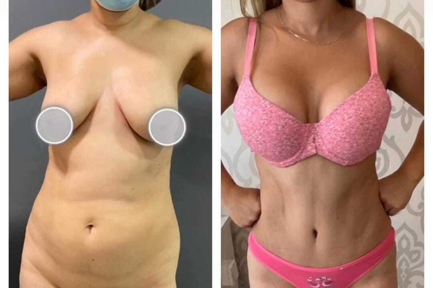 Lipoescultura antes y después - 838882