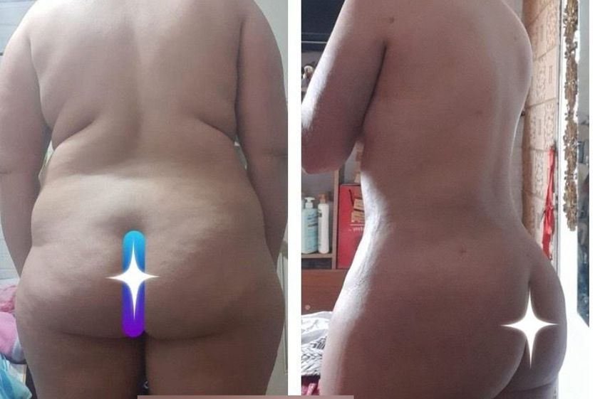 Liposucción antes y después - 862312