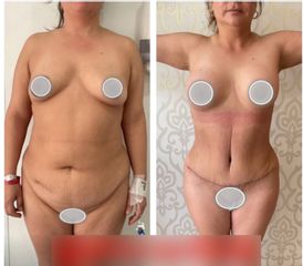 Abdominoplastia - Dr. Brian Frick