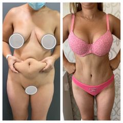 Abdominoplastia - Dr. Brian Frick