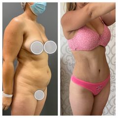 Abdominoplastia - Dr. Brian Frick