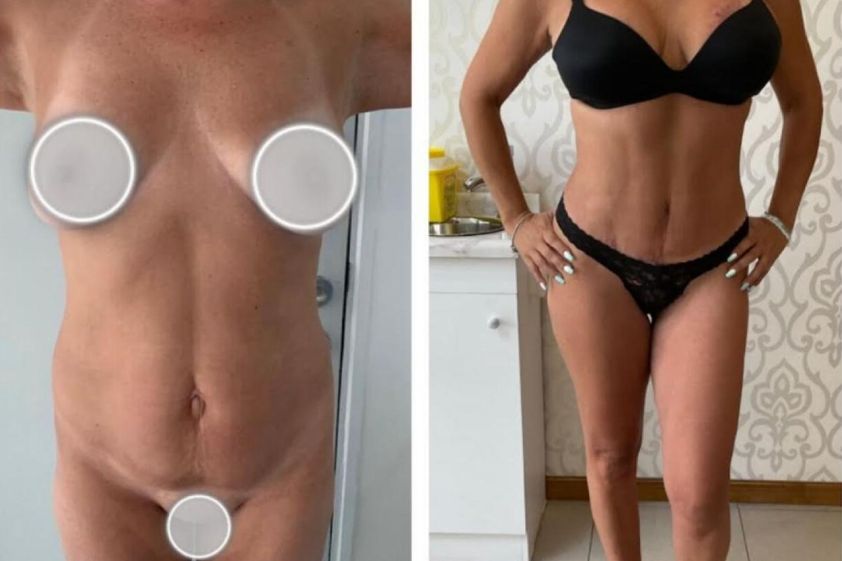 Abdominoplastía antes y después - 864394