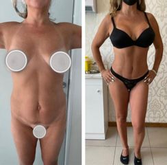 Lipoescultura más Abdominoplastia  - Dr. Brian Frick