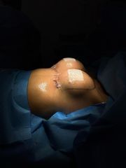 Aumento mamario - Dr. Brian Frick