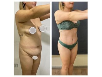 Abdominoplastía antes y después - 878428