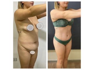Lipoescultura más Abdominoplastia - Dr. Brian Frick