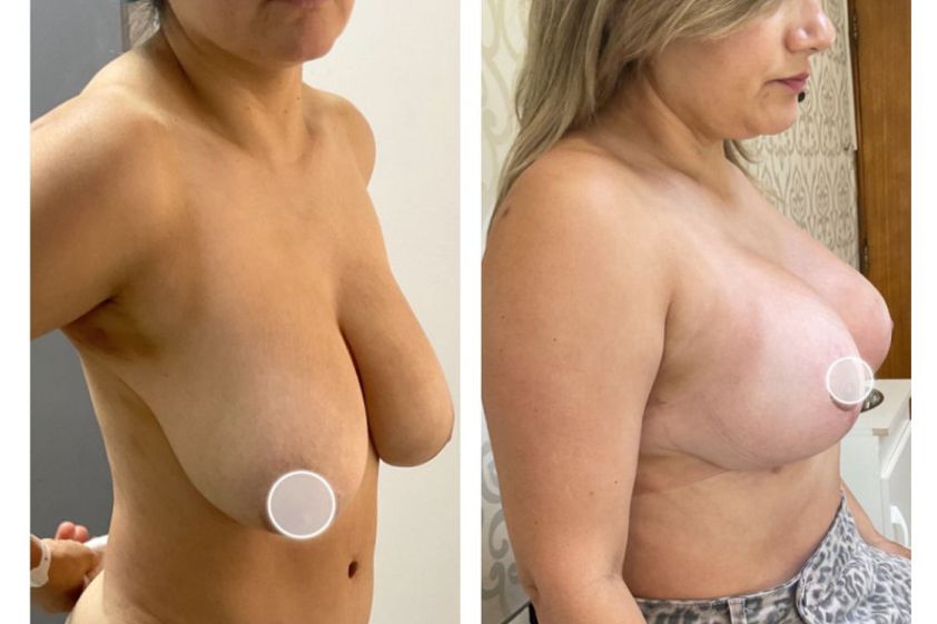 Mastopexia antes y después - 878429