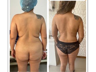 Lipoescultura antes y después - 878431