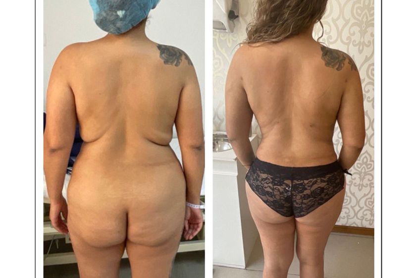 Lipoescultura antes y después - 878431