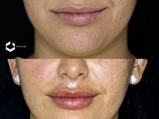 Aumento y Perfilado Labios