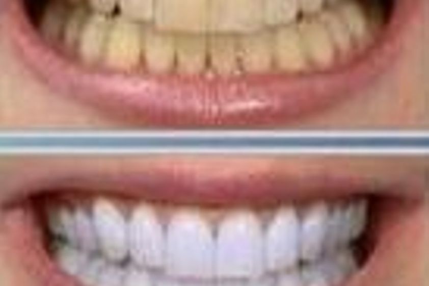 Blanquear dientes antes y después - 286124