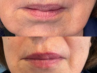 Aumento de labios antes y después - 828589