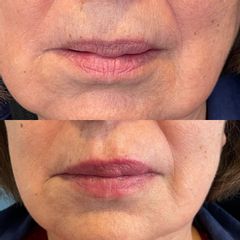 Aumento de labios - Cirugía Plástica Integral Frías & Sylvester