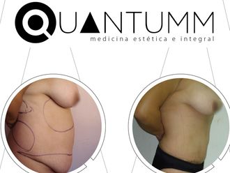 Abdominoplastia - 639447