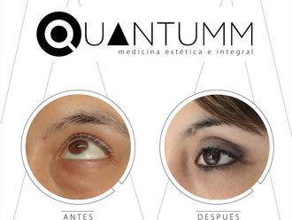 Blefaroplastia - 639448
