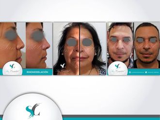 Rejuvenecimiento facial - 641232
