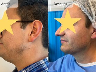 Lipopapada antes y después - 875509