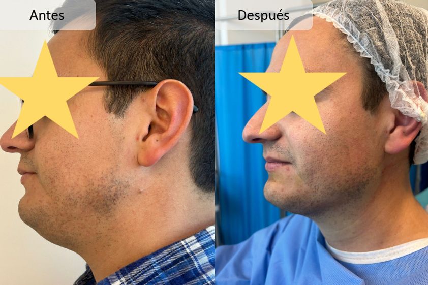 Lipopapada antes y después - 875509
