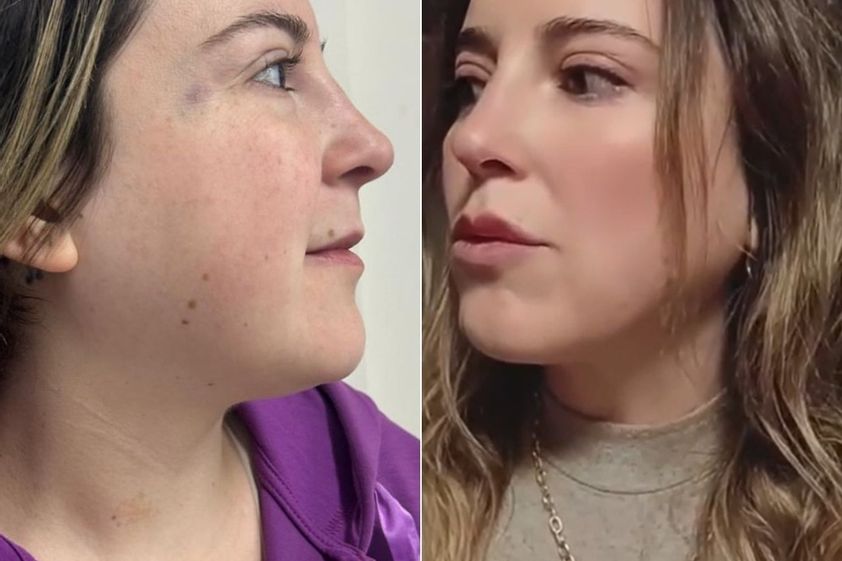 Lipopapada antes y después - 875510