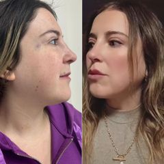 Lipopapada y Bichectomía - Dra. Marleen Saavedra Villalobos