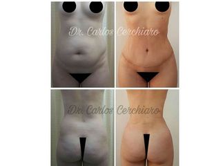 ABDOMINOPLASTIA + LIPOESCULTURA + TRANSFERENCIA A GLUTEOS