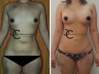 LIPOESCULTURA HD + IMPLANTE MAMARIO
