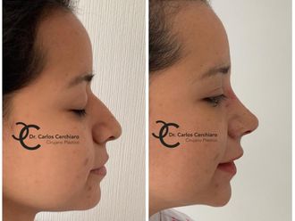 Rinoplastia - 635497