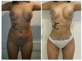 LIPOESCULTURA VASER + IMPLANTES MAMARIOS