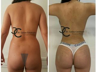 LIPOESCULTURA VASER + TRANSFERENCIA GLUTEA