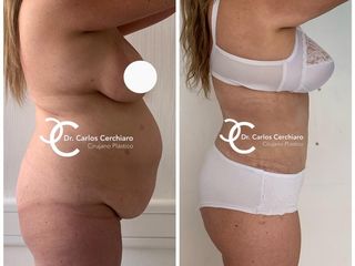 ABDOMINOPLASTIA + LIPOESCULTURA 