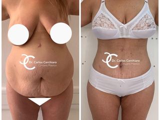 ABDOMINOPLASTIA + LIPOESCULTURA 