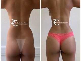 LIPOESCULTURA HD + TRANSFERENCIA A GLÚTEOS