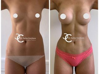 LIPOESCULTURA HD + IMPLANTE MAMARIO