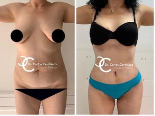 ABDOMINOPLASTIA + LIPOESCULTURA 