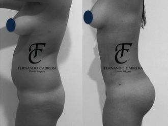 Lipoescultura - 636112