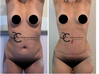 ABDOMINOPLASTIA + LIPOESCULTURA 