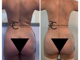 LIPOESCULTURA + TRANSFERENCIA A GLUTEOS 