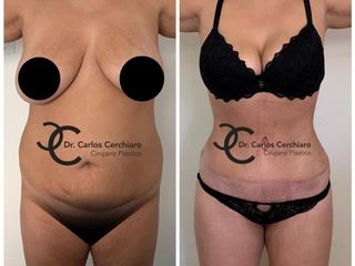 ABDOMINOPLASTIA + LIPOESCULTURA 