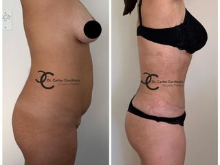 ABDOMINOPLASTIA + LIPOESCULTURA + TRANFERENCIA A GLUTEOS