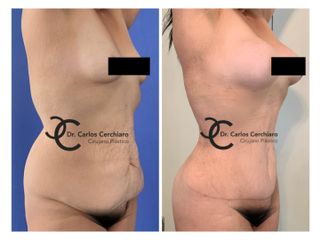 ABDOMINOPLASTIA + LIPOESCULTURA + TRANSFERENCIA A GLÚTEOS + AUMENTO MAMARIO CON PRÓTESIS