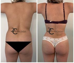 LIPOESCULTURA + TRANSFERENCIA A GLUTEOS 