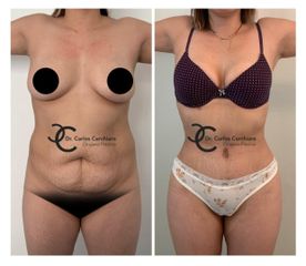 ABDOMINOPLASTIA + LIPOESCULTURA 