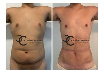 MINI ABDOMINOPLASTIA + LIPOESCULTURA VASER