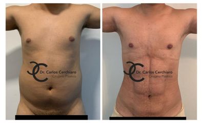 LIPOESCULTURA VASER + MARCACION ABDOMINAL